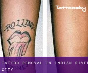 Tattoo Removal in Indian River City
