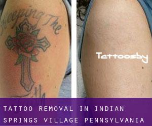 Tattoo Removal in Indian Springs Village (Pennsylvania)