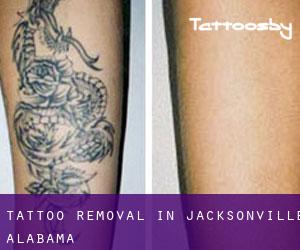 Tattoo Removal in Jacksonville (Alabama)