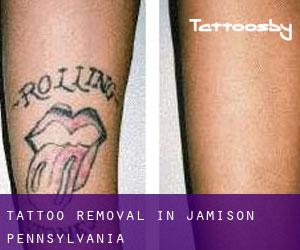 Tattoo Removal in Jamison (Pennsylvania)