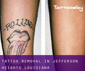 Tattoo Removal in Jefferson Heights (Louisiana)