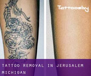 Tattoo Removal in Jerusalem (Michigan)