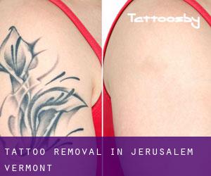 Tattoo Removal in Jerusalem (Vermont)