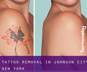 Tattoo Removal in Johnson City (New York)