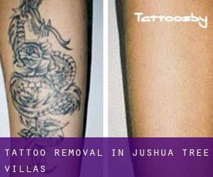 Tattoo Removal in Jushua Tree Villas