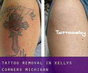 Tattoo Removal in Kellys Corners (Michigan)