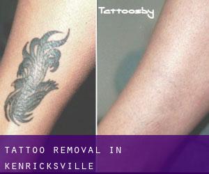 Tattoo Removal in Kenricksville