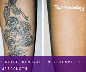 Tattoo Removal in Keyesville (Wisconsin)