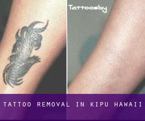 Tattoo Removal in Kīpū (Hawaii)