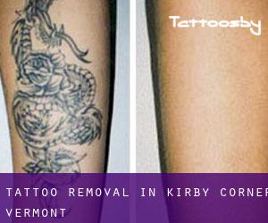 Tattoo Removal in Kirby Corner (Vermont)