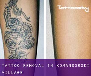 Tattoo Removal in Komandorski Village
