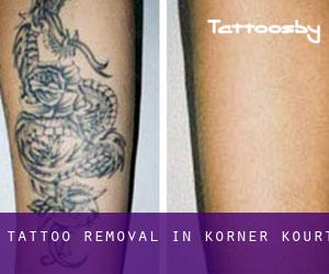 Tattoo Removal in Korner Kourt