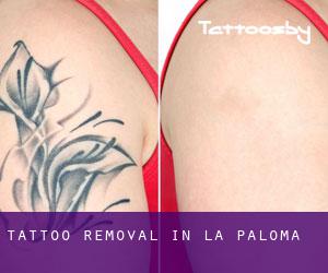 Tattoo Removal in La Paloma