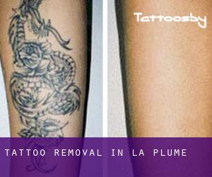 Tattoo Removal in La Plume