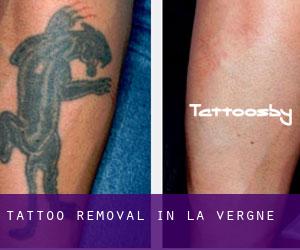 Tattoo Removal in La Vergne