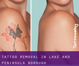 Tattoo Removal in Lake and Peninsula Borough