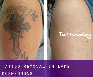Tattoo Removal in Lake Koshkonong