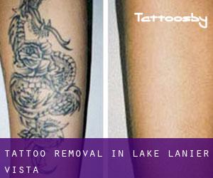 Tattoo Removal in Lake Lanier Vista