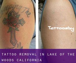 Tattoo Removal in Lake of the Woods (California)