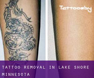 Tattoo Removal in Lake Shore (Minnesota)