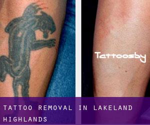 Tattoo Removal in Lakeland Highlands