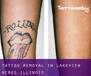 Tattoo Removal in Lakeview Acres (Illinois)