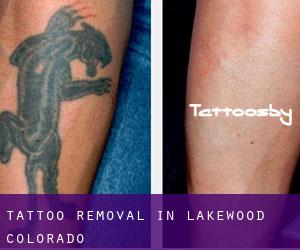 Tattoo Removal in Lakewood (Colorado)