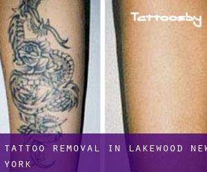 Tattoo Removal in Lakewood (New York)