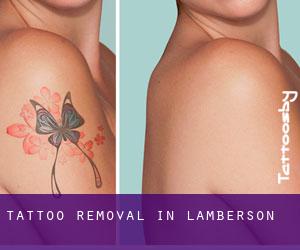 Tattoo Removal in Lamberson