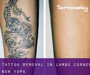 Tattoo Removal in Lambs Corner (New York)