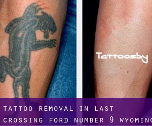 Tattoo Removal in Last Crossing Ford Number 9 (Wyoming)