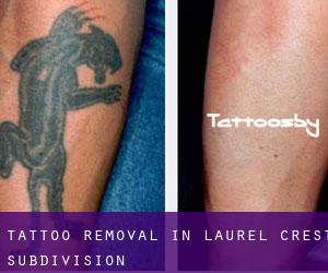 Tattoo Removal in Laurel Crest Subdivision
