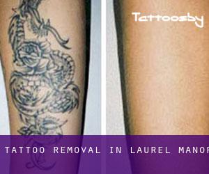 Tattoo Removal in Laurel Manor