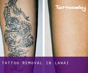 Tattoo Removal in Lawai