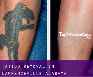 Tattoo Removal in Lawrenceville (Alabama)