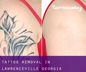 Tattoo Removal in Lawrenceville (Georgia)
