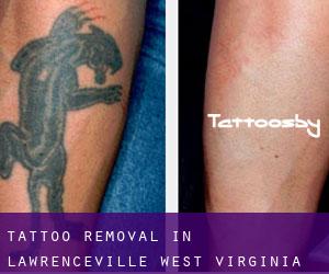 Tattoo Removal in Lawrenceville (West Virginia)