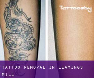 Tattoo Removal in Leamings Mill