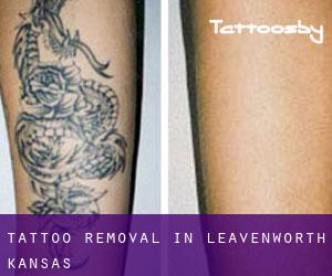 Tattoo Removal in Leavenworth (Kansas)