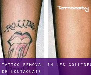 Tattoo Removal in Les Collines-de-l'Outaouais