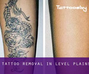 Tattoo Removal in Level Plains