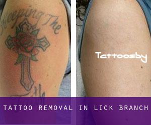 Tattoo Removal in Lick Branch