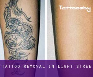 Tattoo Removal in Light Street
