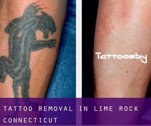 Tattoo Removal in Lime Rock (Connecticut)