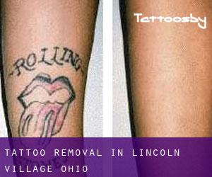 Tattoo Removal in Lincoln Village (Ohio)