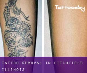 Tattoo Removal in Litchfield (Illinois)