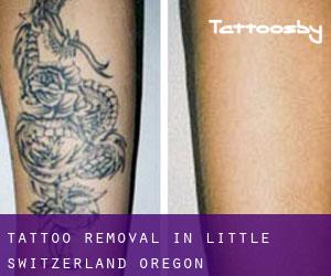 Tattoo Removal in Little Switzerland (Oregon)