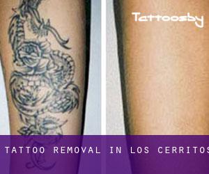 Tattoo Removal in Los Cerritos