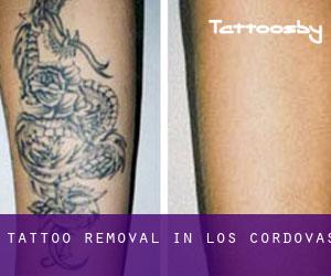 Tattoo Removal in Los Cordovas
