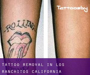 Tattoo Removal in Los Ranchitos (California)